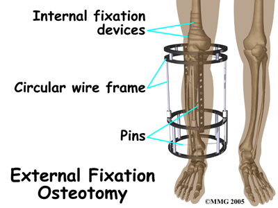child_knee_blounts_surg_extfix01