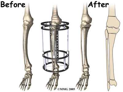 child_knee_blounts_surg_extfix02
