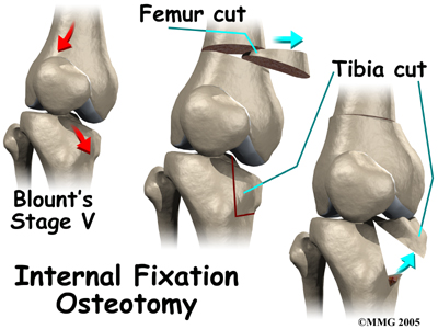 child_knee_blounts_surg_intfix01