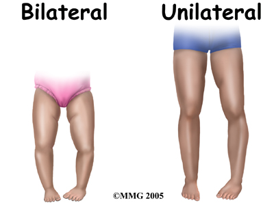 child_knee_blounts_symptoms01