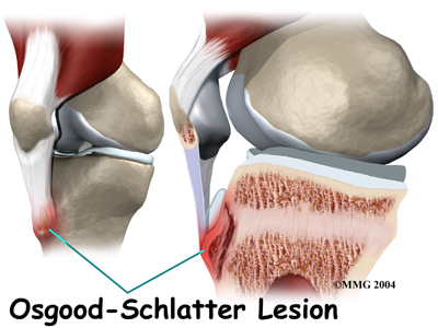 child_knee_osgood_causes03