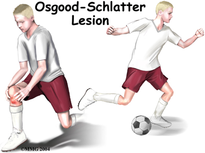 child_knee_osgood_intro01