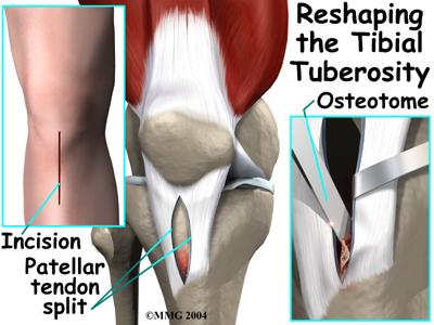 Osgood-Schlatter Lesion of the Kneen | Central Orthopedic Group