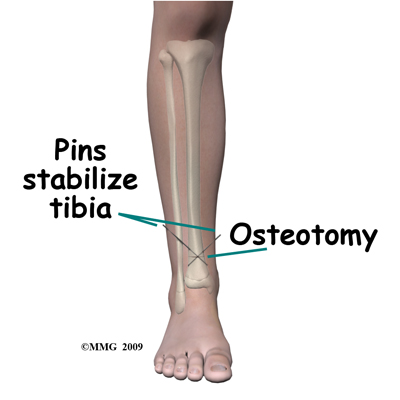 child_rotational_def_pins