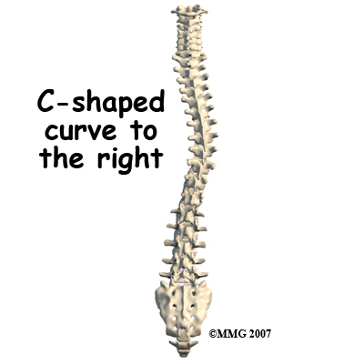 child_scoliosis_cause01