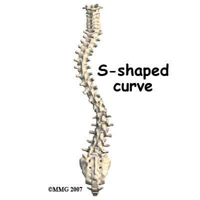 child_scoliosis_cause02