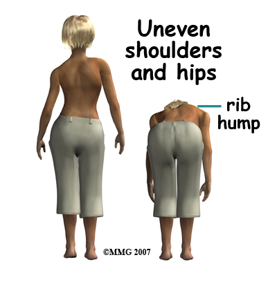 child_scoliosis_symptom01