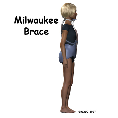 child_scoliosis_treatment01