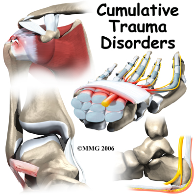 cumulative_trauma01