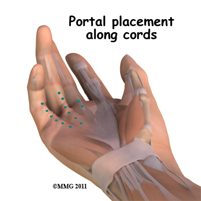 dupuytrens_aponeurotomy_portals