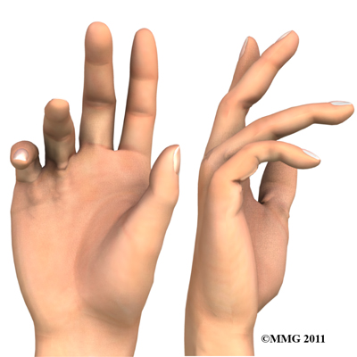 dupuytrens_contracture_hands