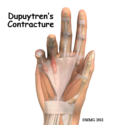 dupuytrens_contracture_new_intro