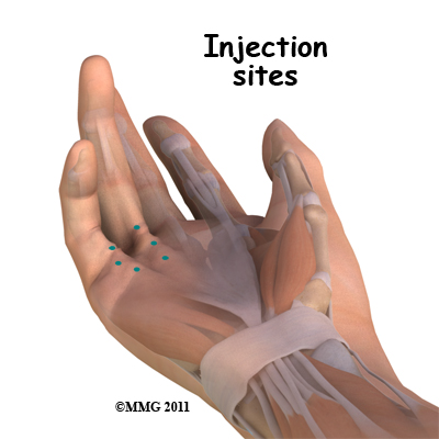 dupuytrens_injection_sites