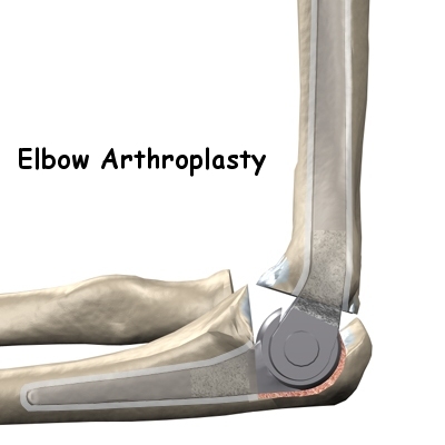 elbow_arthro_intro01