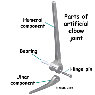 elbow_arthro_surgery02