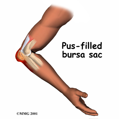 elbow_bursitis_cause02