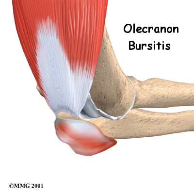 elbow_bursitis_intro01