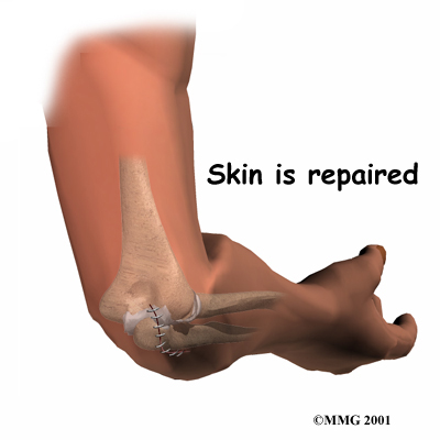 elbow_bursitis_surgery04