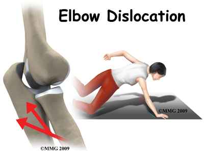 elbow_dislocation_intro01