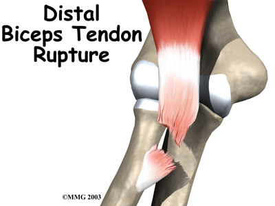 elbow_distal_biceps_rupture_intro01