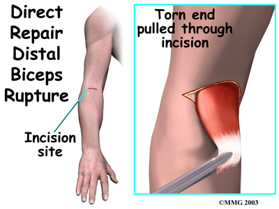 elbow_distal_biceps_rupture_surg01