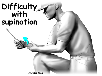 elbow_distal_biceps_rupture_treatment01