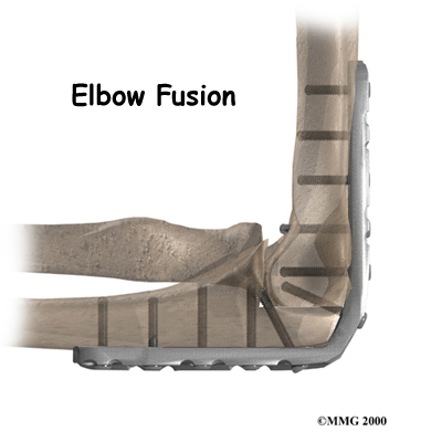 elbow_fusion_intro01
