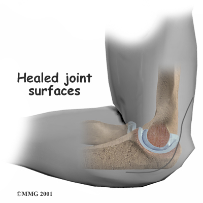 elbow_interpos_surgery03