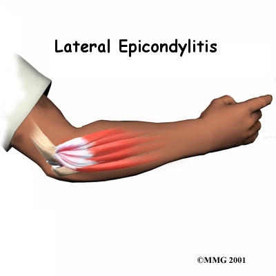 elbow_latepi_intro01