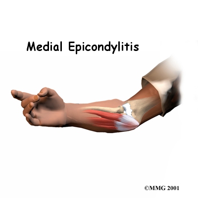 elbow_medepi_intro01