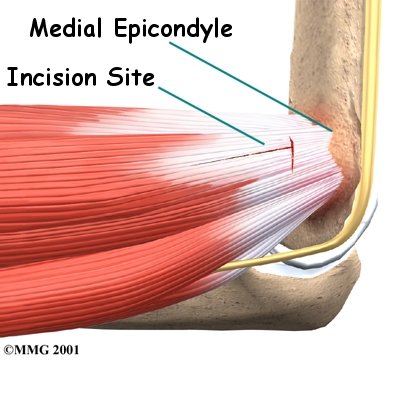 elbow_medepi_surgery01