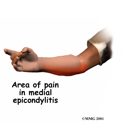 elbow_medepi_symptom01