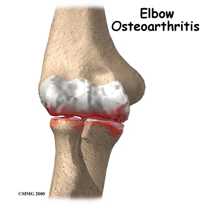 elbow_oa_intro01