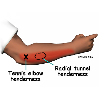 elbow_radtun_symptoms01