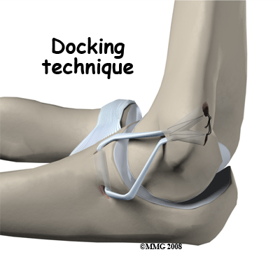 elbow_uclr_docking