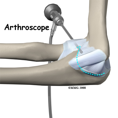 elbow_ucl_injury_diagnosis02