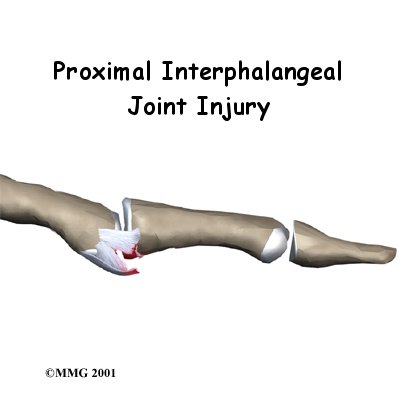 finger_PIPinjury_intro01