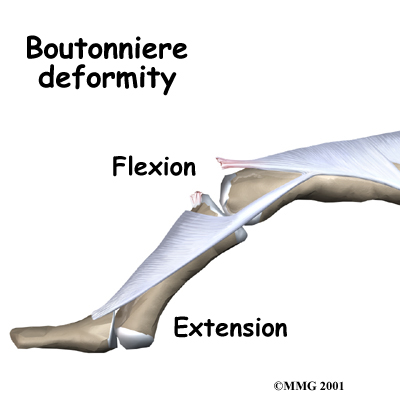 finger_bouton_cause03