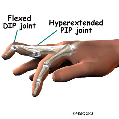finger_swanneck_cause01