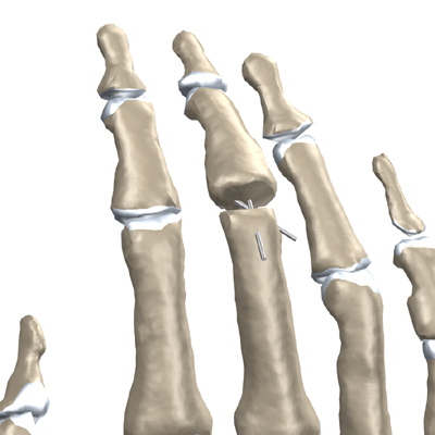 finger_swanneck_surgery02