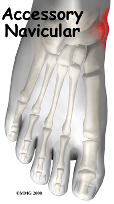 foot_accessory_navicular_intro01