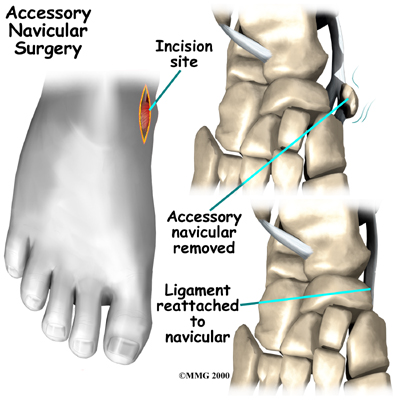 foot_accessory_navicular_treatment01