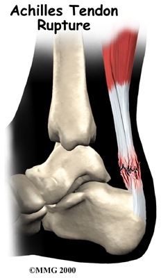 foot_achilles_tendon_intro01