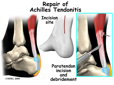 foot_achilles_tendon_treatment01