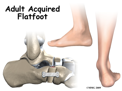 foot_acquired_flatfoot_intro01
