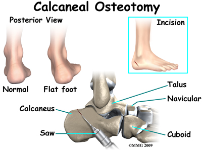 foot_acquired_flatfoot_surgery02