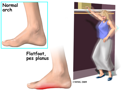 foot_acquired_flatfoot_symptoms01