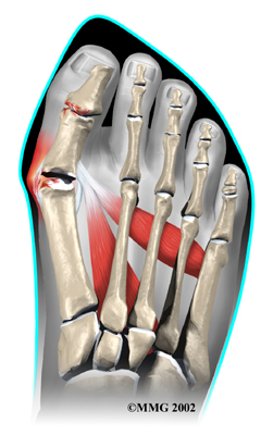 foot_bunion_causes01