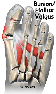 foot_bunion_intro01