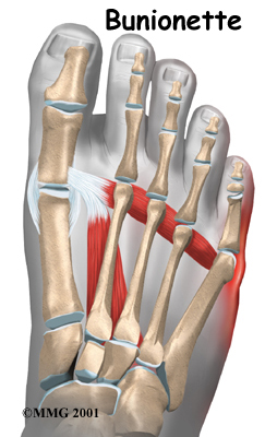 foot_bunionette_intro01